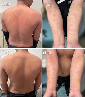 Case report: Clinical and histopathological characteristics of psoriasiform erythema and de novo IL-17A cytokines expression on lesioned skin in atopic dermatitis children treated with dupilumab